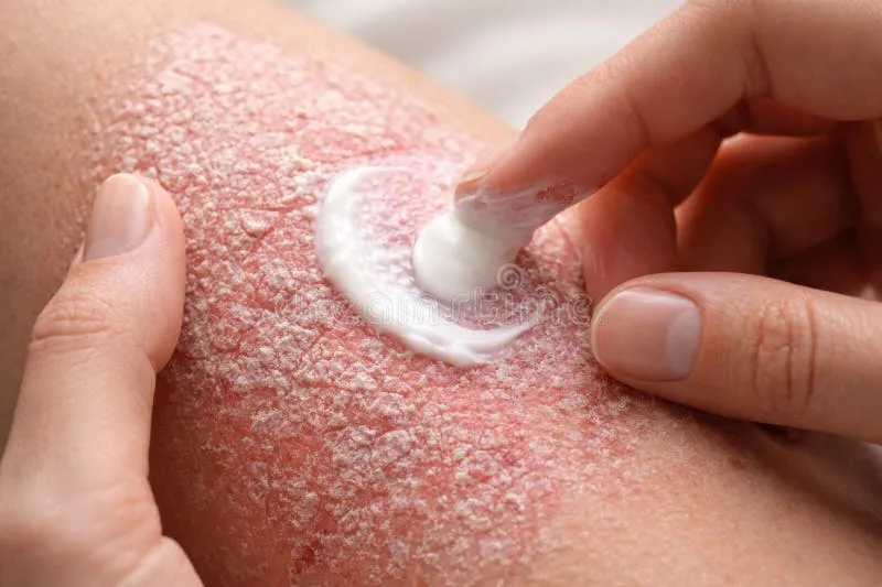 Pelle che si squama: quando è normale e quando richiede l'intervento del dermatologo