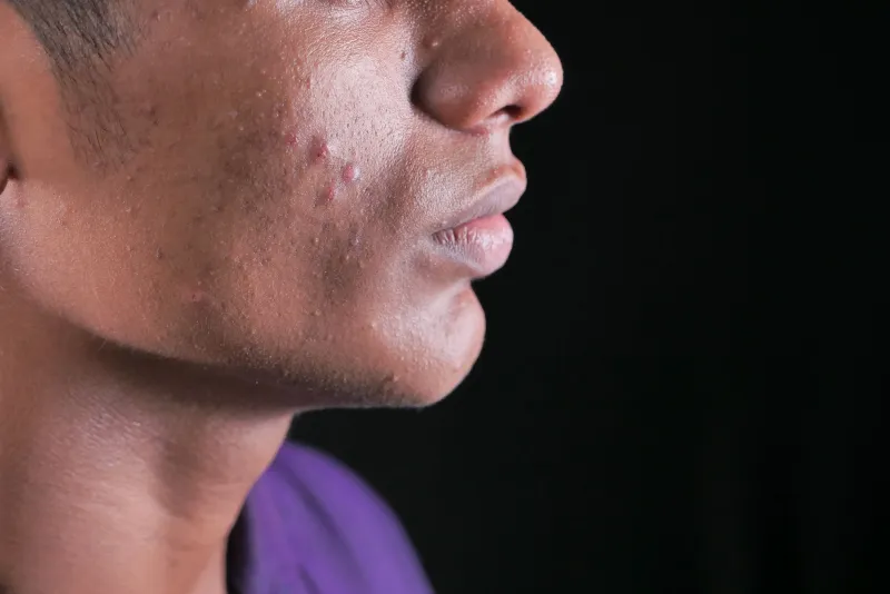 Pori dilatati e seborrea: cosa li causa davvero e come i trattamenti dermatologici li riducono visibilmente